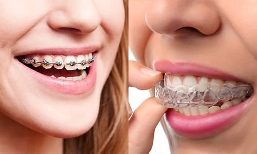 Orthodontic Dentistry and Aligner